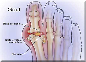 Gout